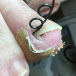 【巻き爪】爪トゲ