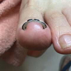 矯正後