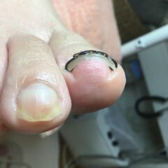 矯正後