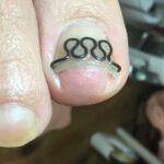 【巻き爪】食い込みの跡