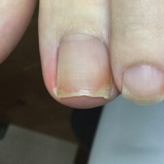 矯正前