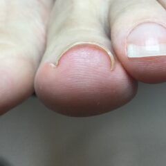 矯正前