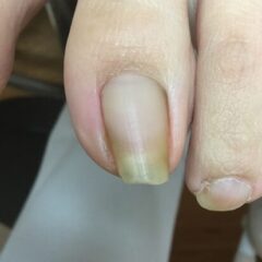 矯正前