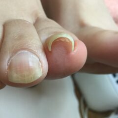 矯正前