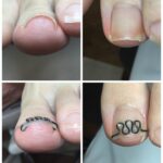 【巻き爪】ビフォーアフター写真