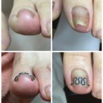 【巻き爪】ビフォーアフター写真
