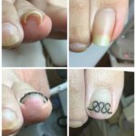 【巻き爪】ビフォーアフター写真