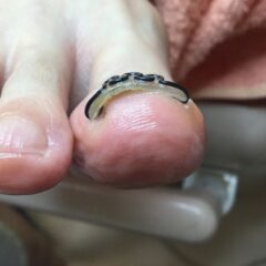 矯正後