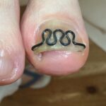 【巻き爪】食い込みの跡