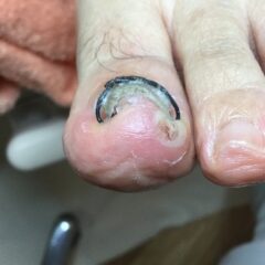矯正後