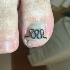 矯正後