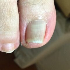 矯正前