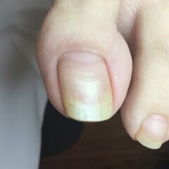 矯正前
