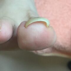 矯正前