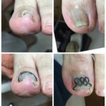 【巻き爪】ビフォーアフター写真