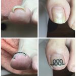 【巻き爪】ビフォーアフター写真