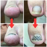 【巻き爪】ビフォーアフター写真