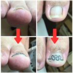 【巻き爪】ビフォーアフター写真