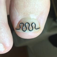 矯正後