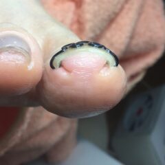 矯正後