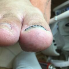 矯正後