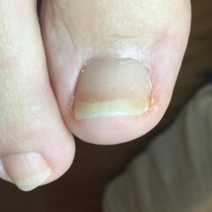 矯正前