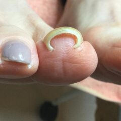 矯正前