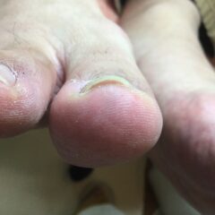 矯正前