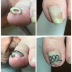 【巻き爪】ビフォーアフター写真