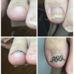 【巻き爪】ビフォーアフター写真