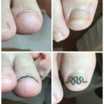 【巻き爪】ビフォーアフター写真
