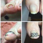 【巻き爪】ビフォーアフター写真