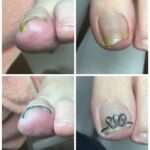【巻き爪】ビフォーアフター写真