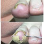皮膚に埋もれていた爪