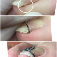 【巻き爪】ビフォーアフター写真
