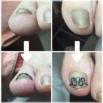 【巻き爪】ビフォーアフター写真