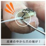 【巻き爪】食い込みの跡