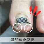 【巻き爪】食い込みの跡
