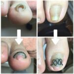 【巻き爪】ビフォーアフター写真