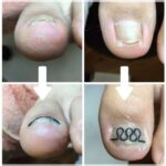 【巻き爪】ビフォーアフター写真