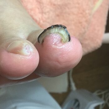 矯正後