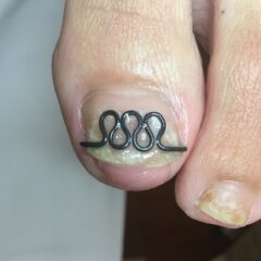 矯正後