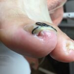【巻き爪】食い込みの跡