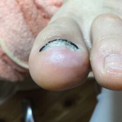 矯正後