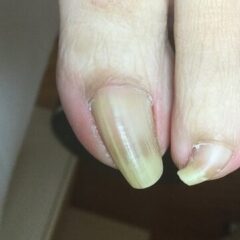矯正前