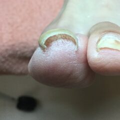 矯正前