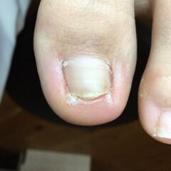 矯正前