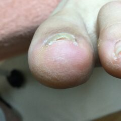 矯正前