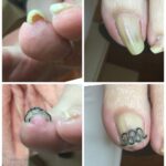 【巻き爪】ビフォーアフター写真