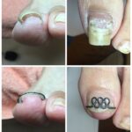 【巻き爪】ビフォーアフター写真